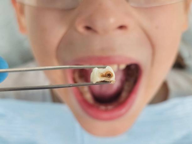 Best Emergency Dental Extractions in Ponderosa Park, CO