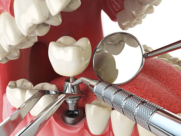 Best Emergency Dental Care for Abscessed Tooth in Ponderosa Park, CO